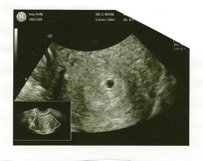 6 недель срок беременной. Плодное яйцо на УЗИ 4 недели. Плодное яйцо на УЗИ 5 недель. УЗИ беременности плодное яйцо 4 недели. Плодное яйцо на 6 неделе беременности УЗИ.